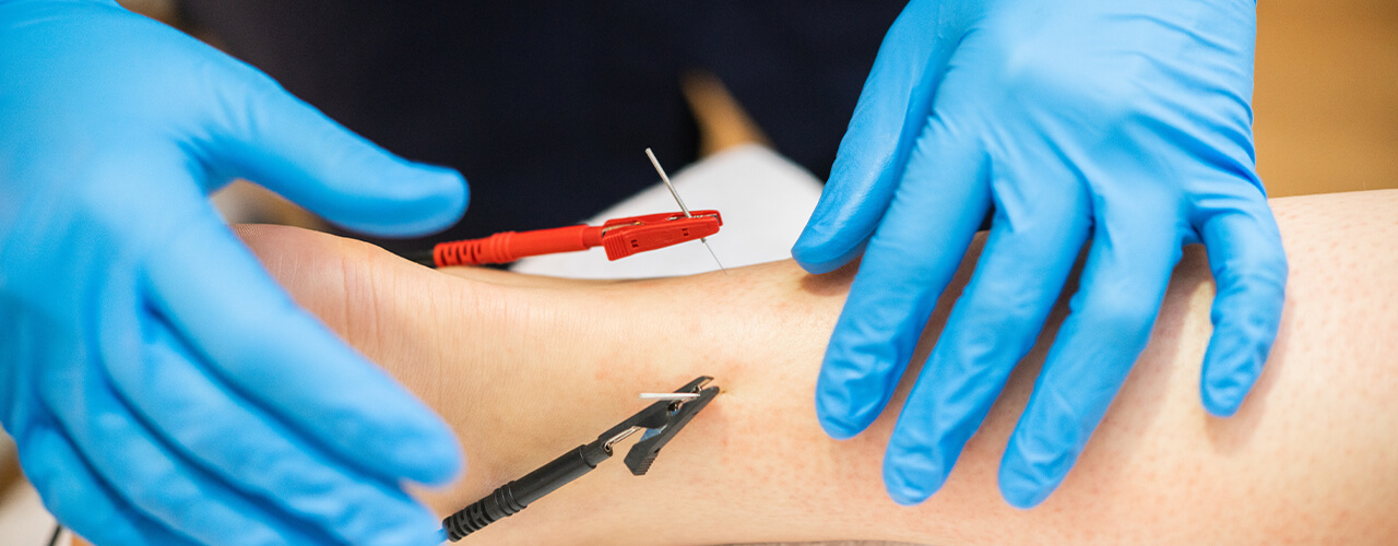 Dry Needling Alexandria, VA