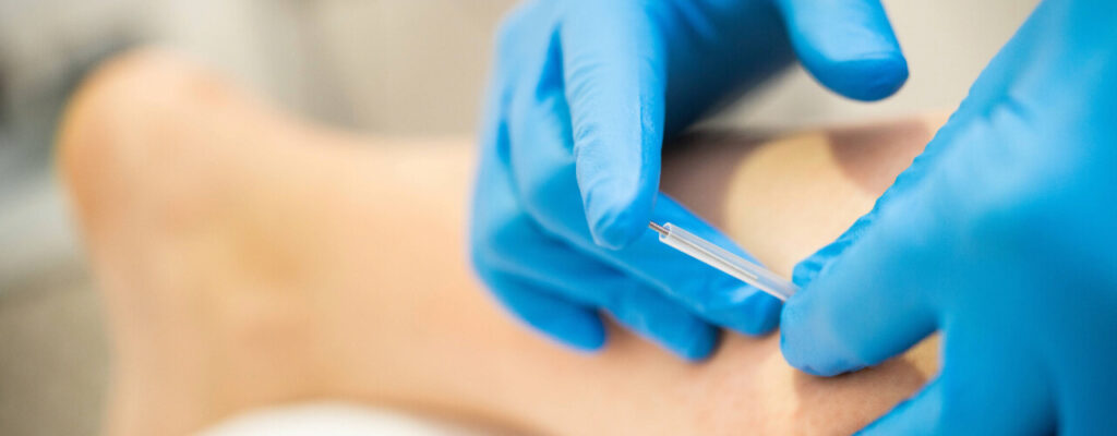 Myths and Facts About Dry Needling